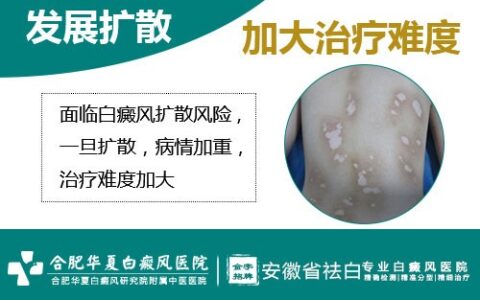 白癜风可能给患者带来的三大危害是什么